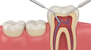 Dente com Canal Pulsando