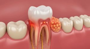 Dor de Dente do Siso