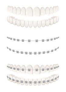Aparelho Dental - Dra. Shirlene Oliveira