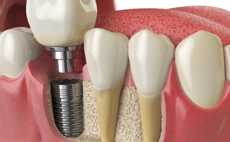  Implante dentário em Campinas: o que é e quais os benefícios