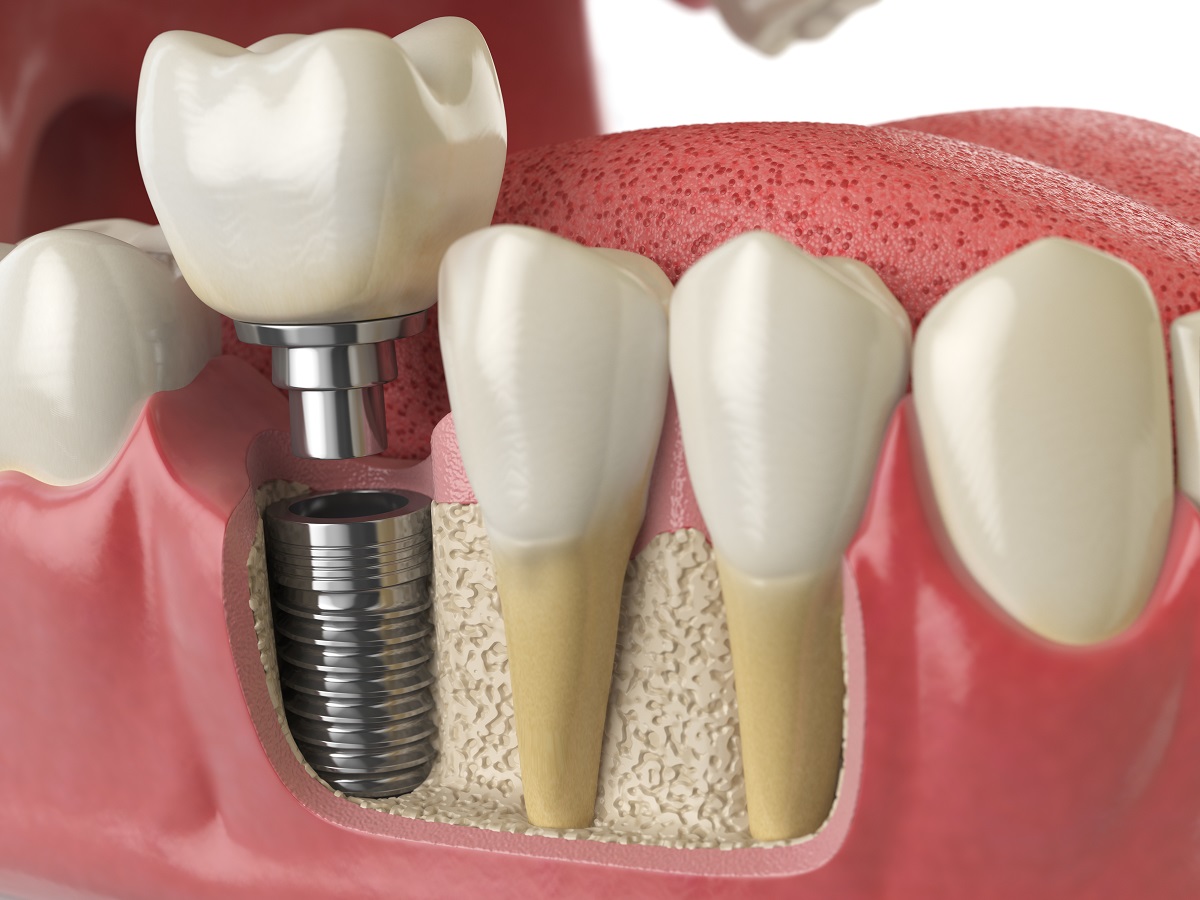 Implante dentário em Campinas – o que é e quais os benefícios