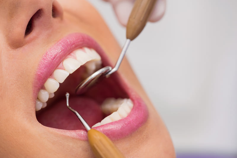 Limpeza Dental Campinas – 5 Dicas