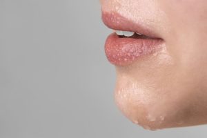 Ressecamento Labial Ressecamento Labial