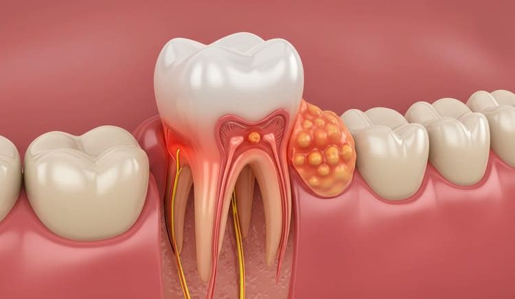  7 Causas Comuns da Dor de Dente do Siso – Dra Shirlene Oliveira