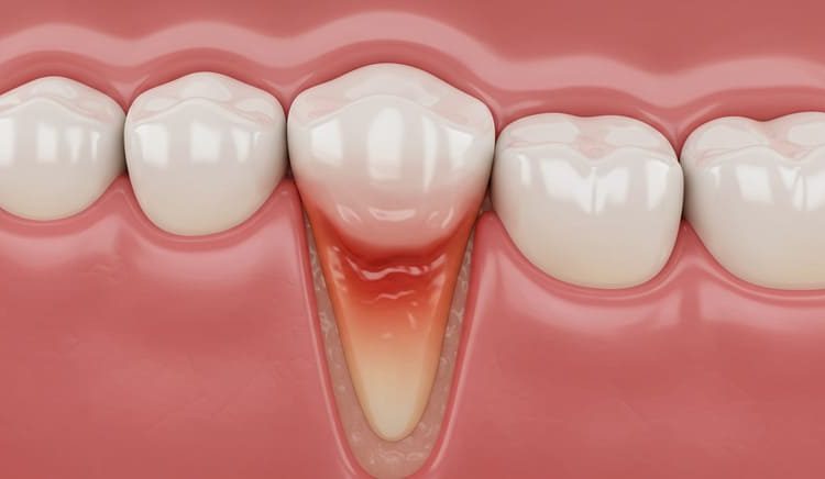  5 Fatos Importantes sobre Gengivite – Dra. Shirle Oliveira