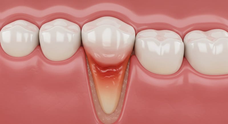 5 Fatos Importantes sobre Gengivite – Dra. Shirle Oliveira