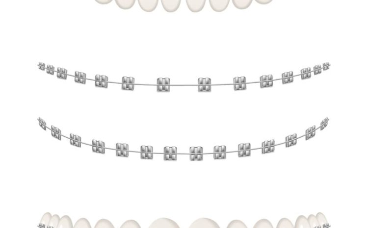  6 Vantagens de Usar Aparelho Dental – Dra. Shirlene Oliveira