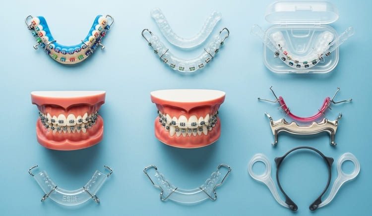  5  Tipos de Aparelho Ortodôntico – Dicas da Dra. Shirlene Oliveira para um Sorriso Perfeito