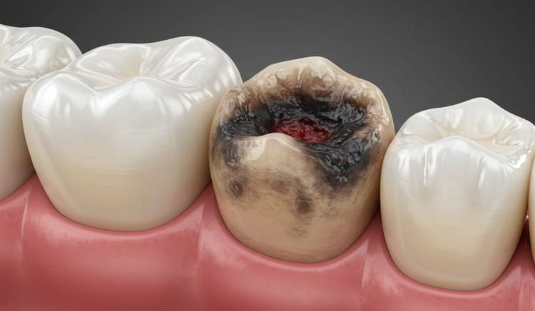 7 Verdades Que Você Precisa Saber Sobre Carie no Dente – Dra. Shirlene Oliveira
