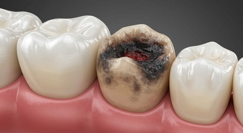 7 Verdades Que Você Precisa Saber Sobre Carie no Dente – Dra. Shirlene Oliveira