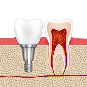 Implantes Dentais Implantes Dentais