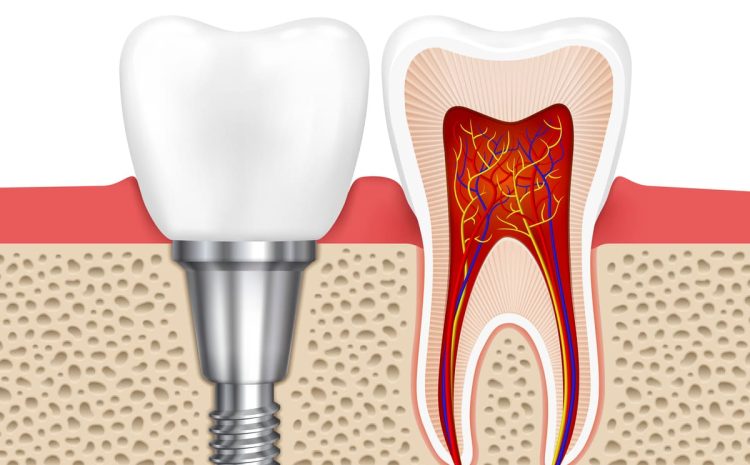  7 Benefícios dos Implantes Dentais para Seu Sorriso