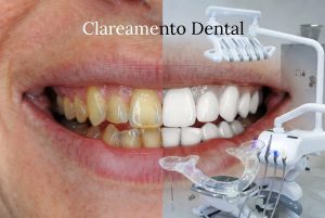 Clareamento dental