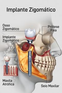 Implantes Zigomáticos