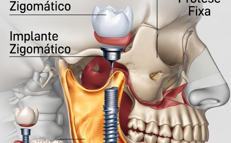  Implantes Zigomáticos: Solução Segura para Perda Óssea Severa