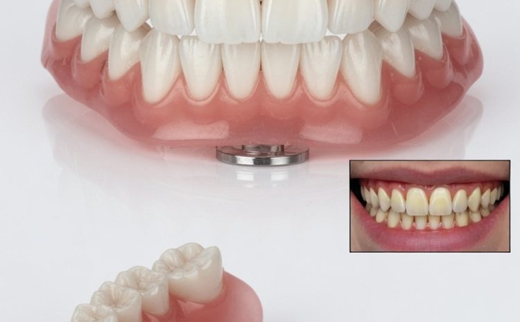  Prótese Dentária Móvel de Silicone: Conforto e Estética Natural