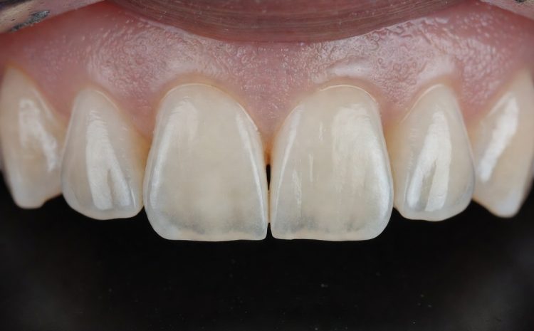  Resina ou Faceta de Porcelana: Qual Escolher para Seu Sorriso?