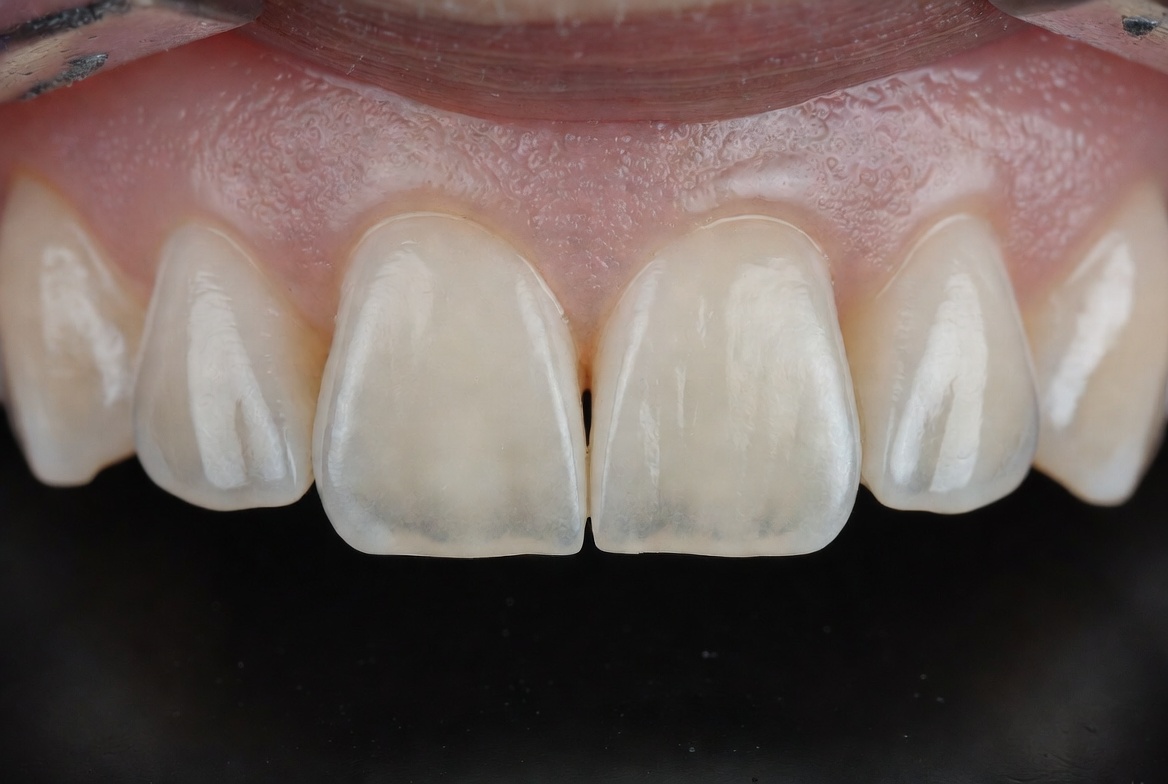 Resina ou Faceta de Porcelana: Qual Escolher para Seu Sorriso?