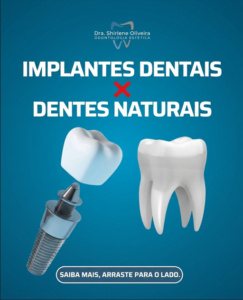 Implantes Dentais x Dentes Naturais Implantes Dentais x Dentes Naturais