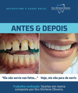 Tratamento Estético Dental Tratamento Estético Dental